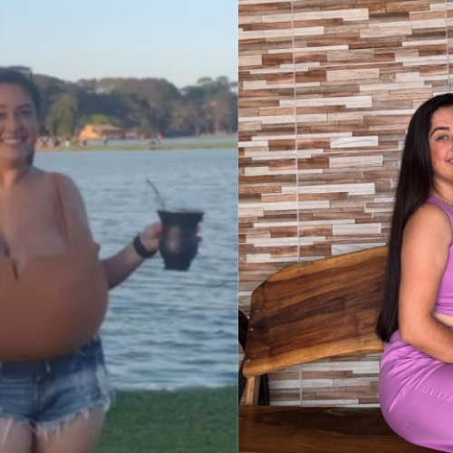 Jovem do Paraná retira 10 kg de mama após diagnóstico de doença rara