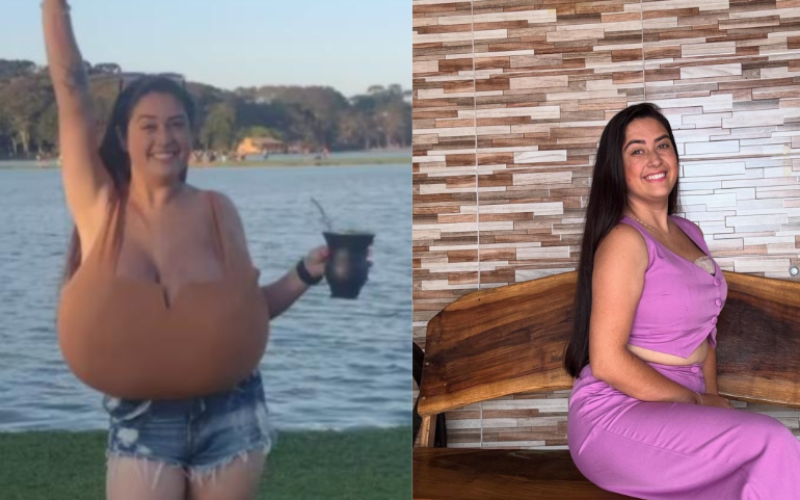 Jovem do Paraná retira 10 kg de mama após diagnóstico de doença rara
